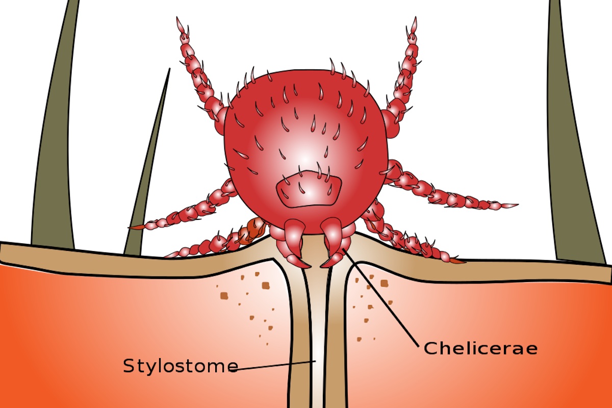 chigger bite